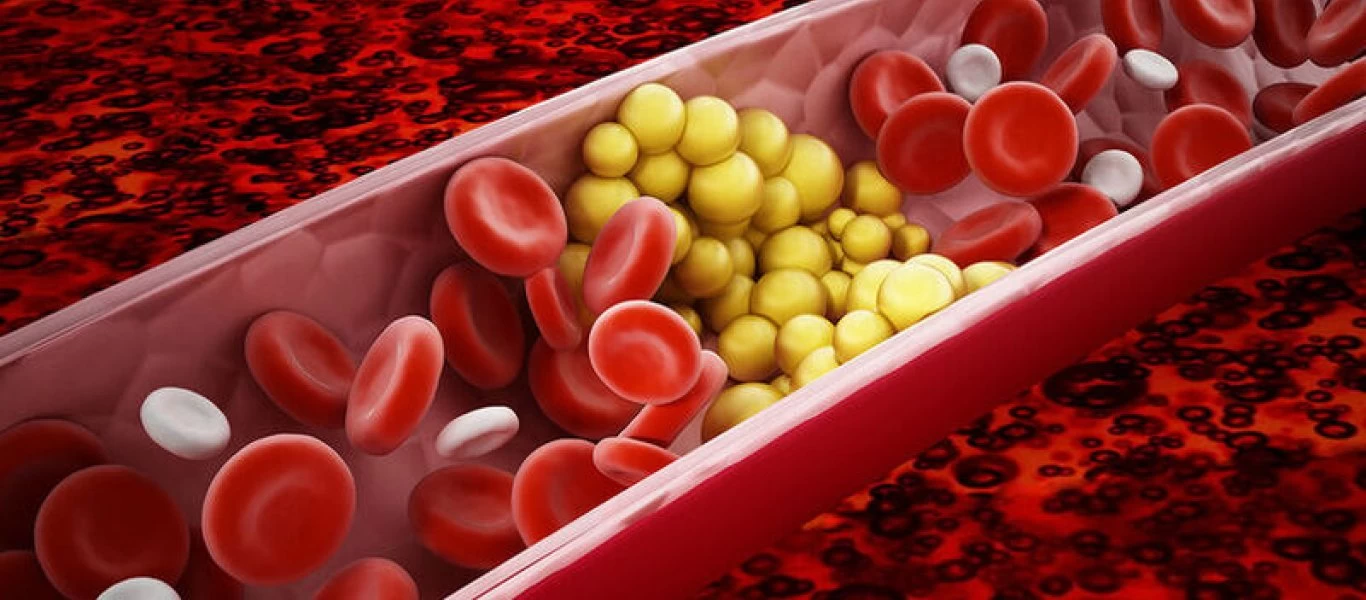 Πόσο ρόλο παίζει τελικά η χοληστερόλη στα καρδιακά νοσήματα;